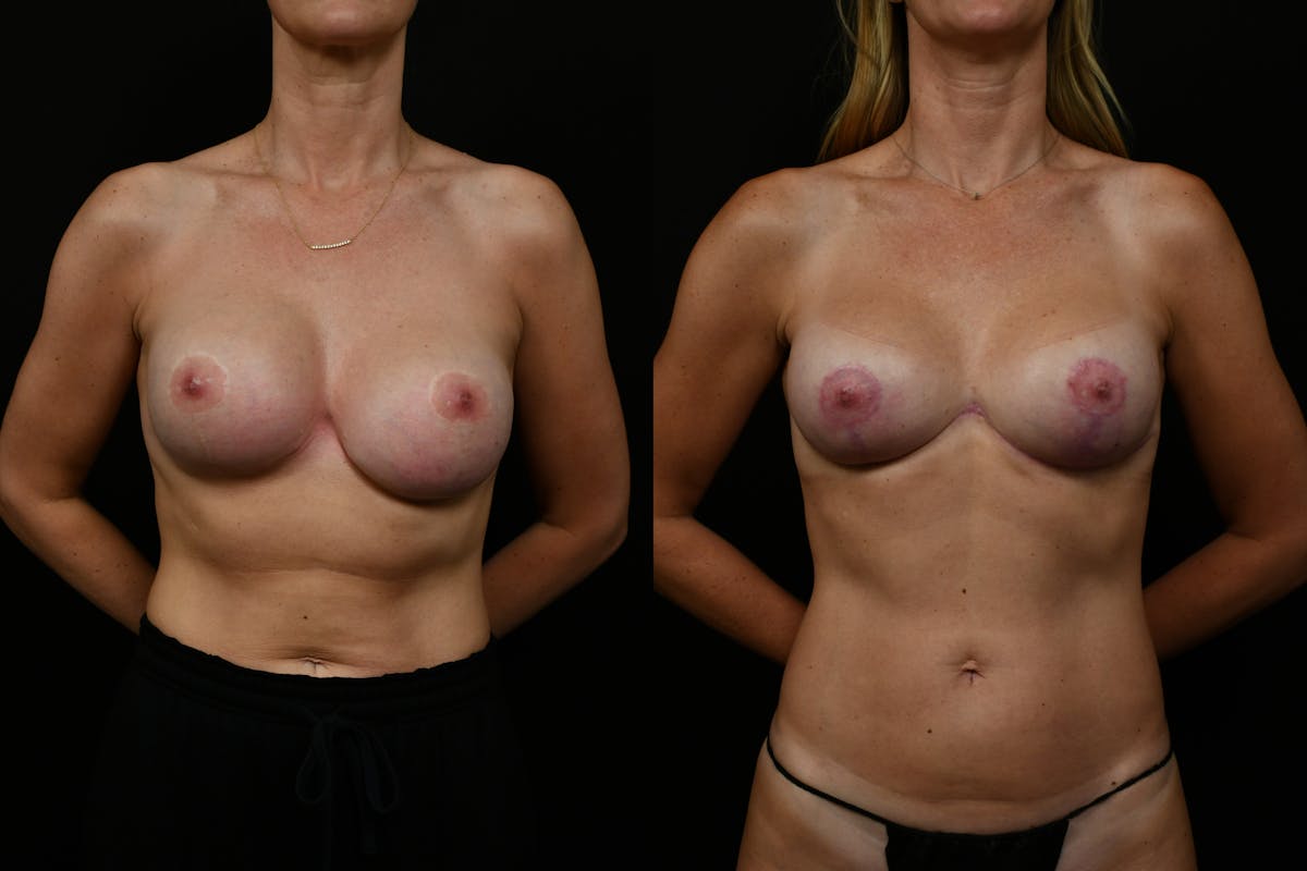 Breast Revision Before & After Gallery - Patient 296110 - Image 1