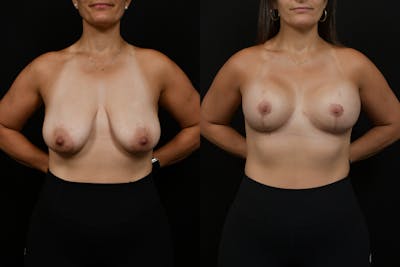 Reductive Augmentation Before & After Gallery - Patient 923363 - Image 1
