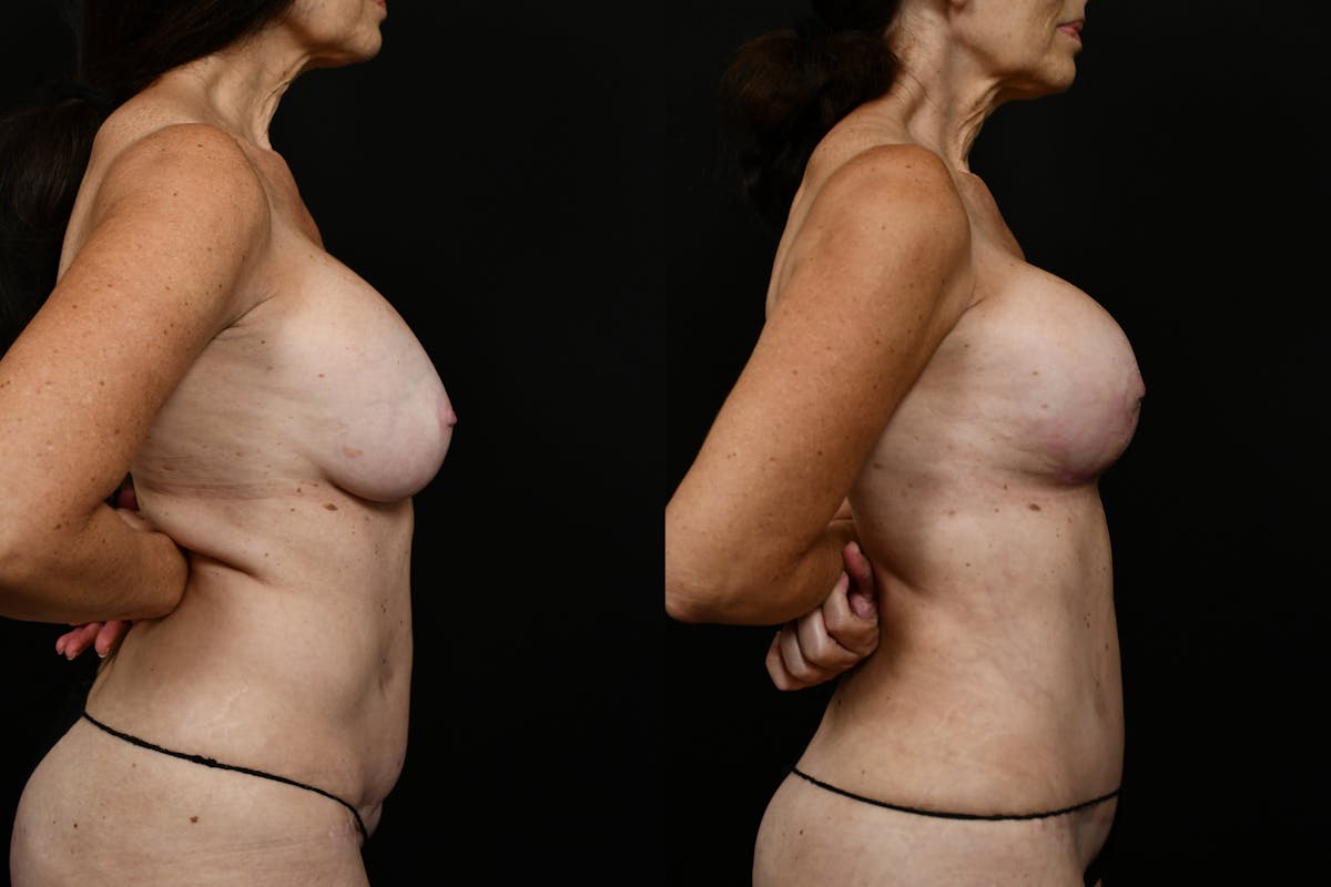 Breast Revision Before & After Gallery - Patient 209400 - Image 3