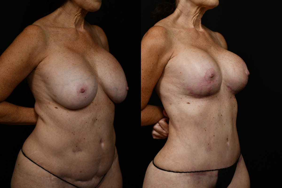Breast Revision Before & After Gallery - Patient 209400 - Image 2