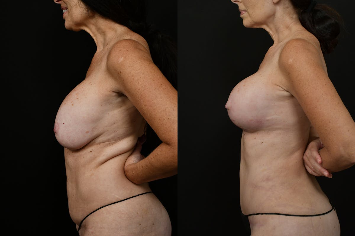 Breast Revision Before & After Gallery - Patient 209400 - Image 5