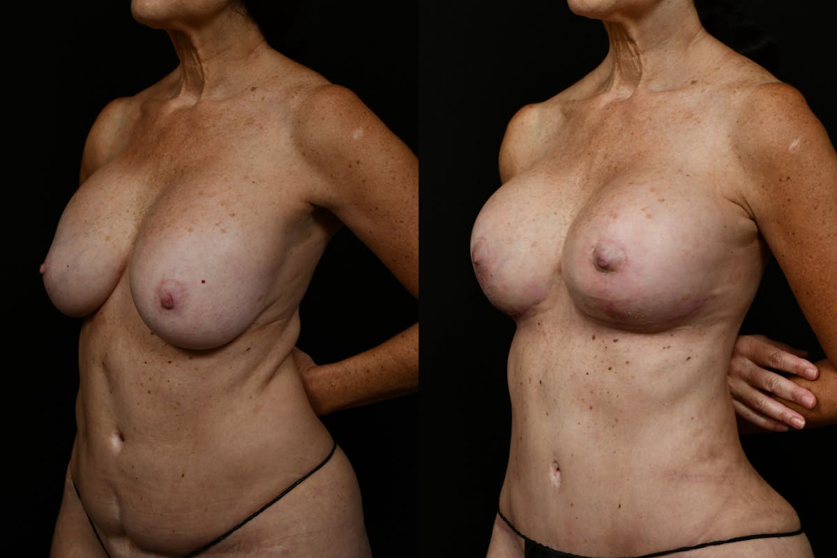 Breast Revision Before & After Gallery - Patient 209400 - Image 4