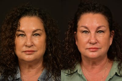 Injectables Before & After Gallery - Patient 727544 - Image 1