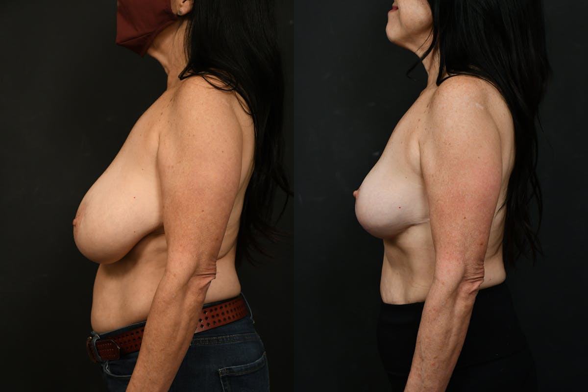 Autologous Implant Before & After Gallery - Patient 147865 - Image 3