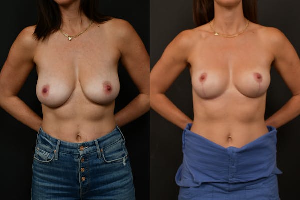 Autologous Implant Before & After Gallery - Patient 154367 - Image 1