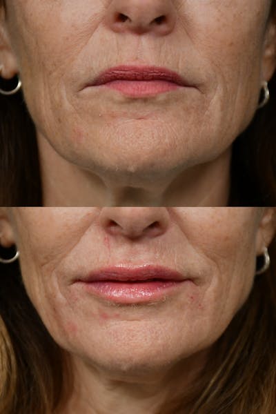 Injectables Before & After Gallery - Patient 172208 - Image 1