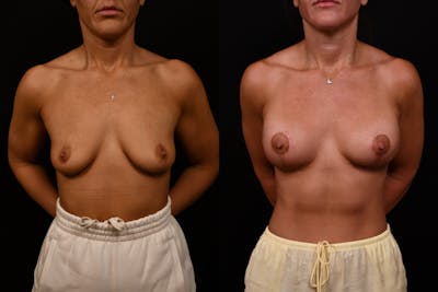 Reductive Augmentation Before & After Gallery - Patient 427275 - Image 1
