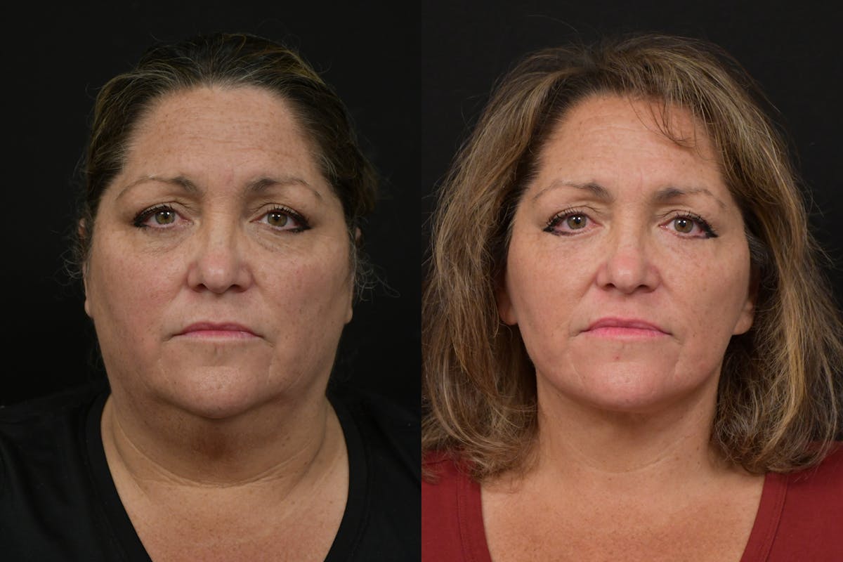 Eyelid Surgery Before & After Gallery - Patient 127260 - Image 1
