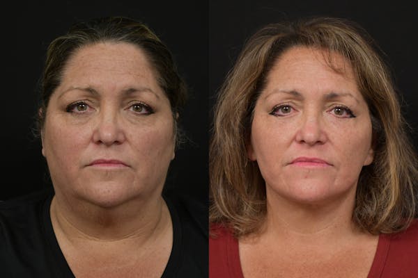 Changes Deep Plane Face Lift  Before & After Gallery - Patient 228546 - Image 1