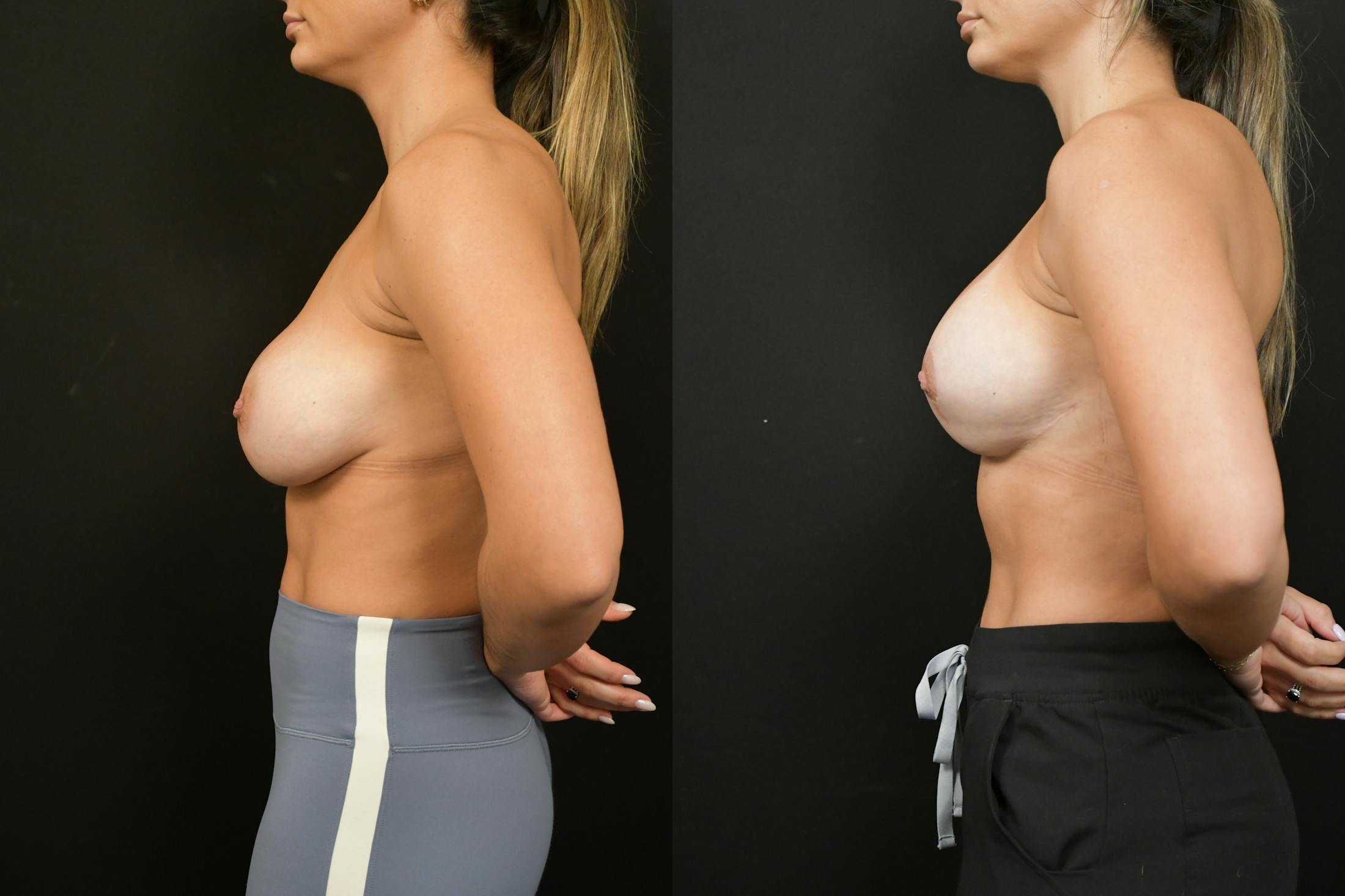 Reductive Augmentation Before & After Gallery - Patient 173954 - Image 3