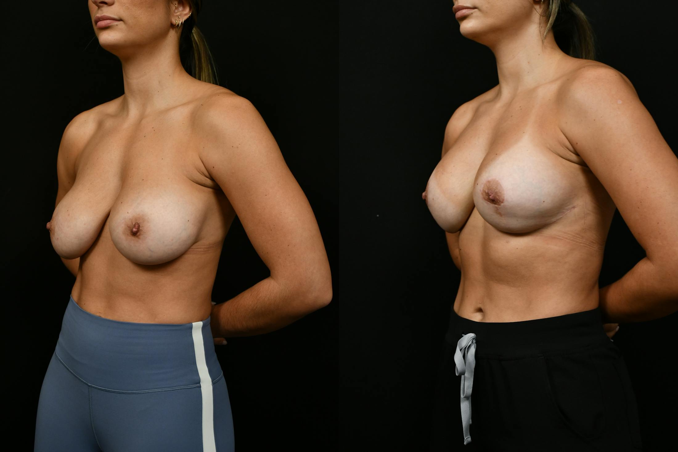 Reductive Augmentation Before & After Gallery - Patient 173954 - Image 2