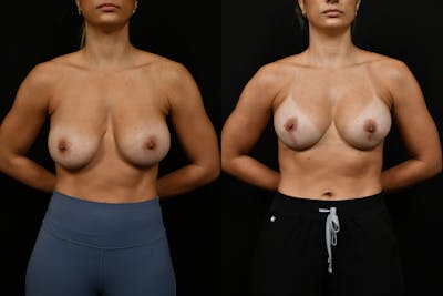 Reductive Augmentation Before & After Gallery - Patient 173954 - Image 1