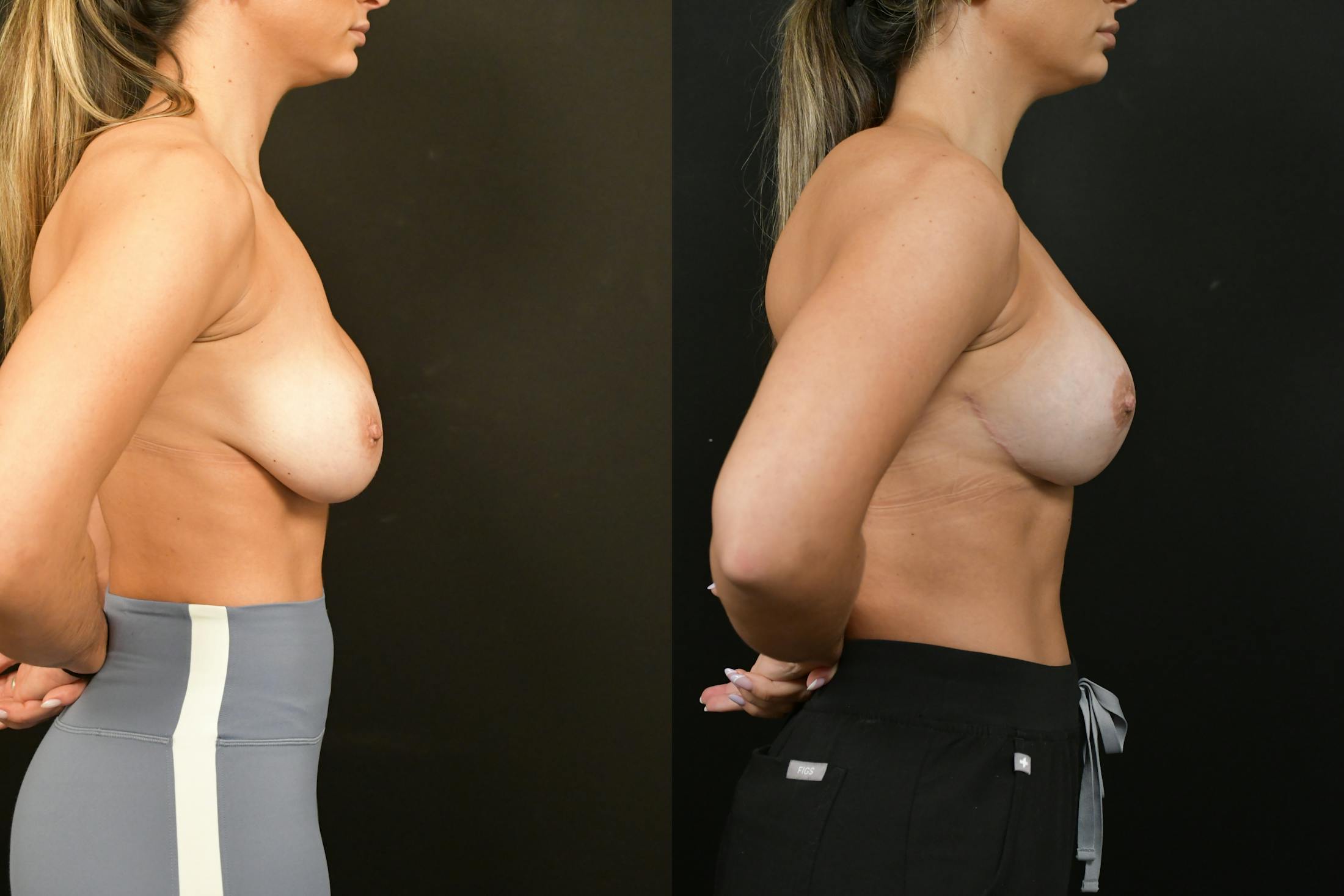 Reductive Augmentation Before & After Gallery - Patient 173954 - Image 5