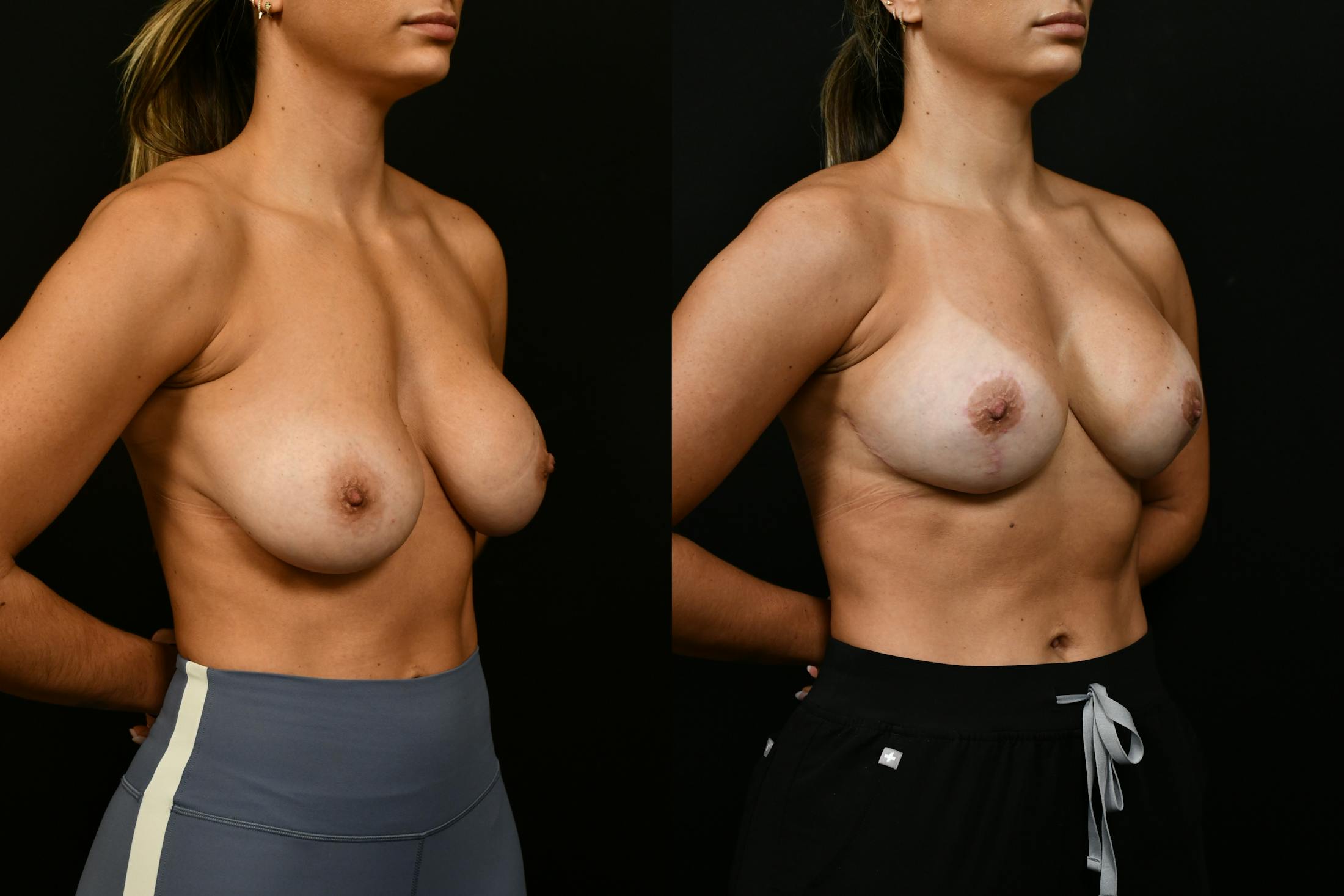 Reductive Augmentation Before & After Gallery - Patient 173954 - Image 4