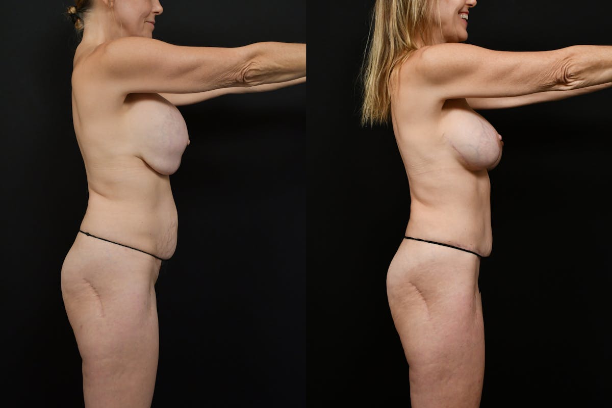 Tummy Tuck Before & After Gallery - Patient 116791 - Image 3