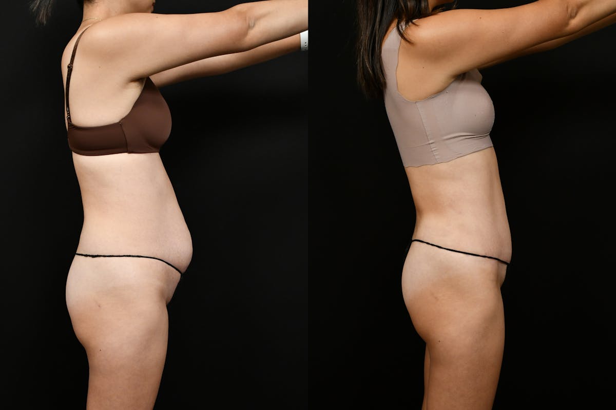Tummy Tuck Before & After Gallery - Patient 144541 - Image 3