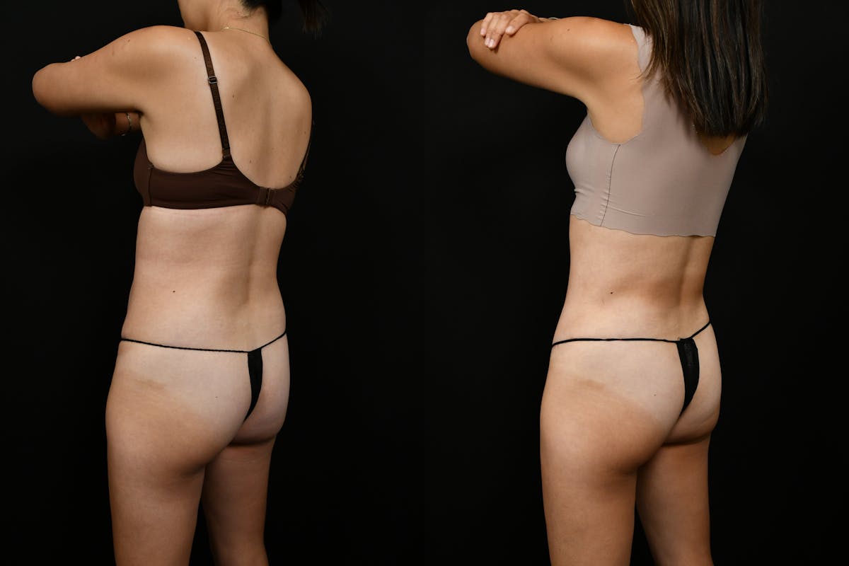 Tummy Tuck Before & After Gallery - Patient 144541 - Image 6