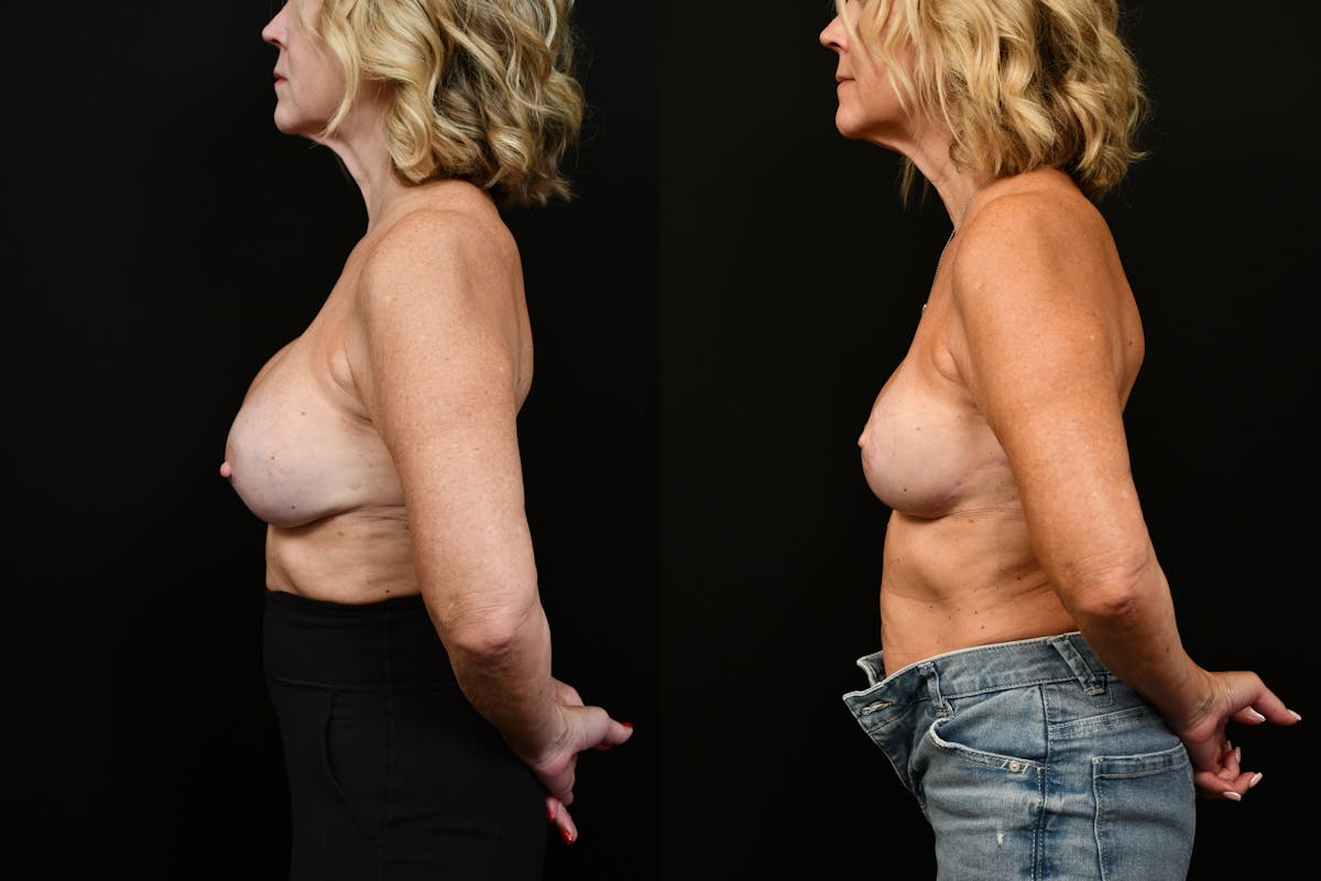 Reductive Augmentation Before & After Gallery - Patient 349280 - Image 5