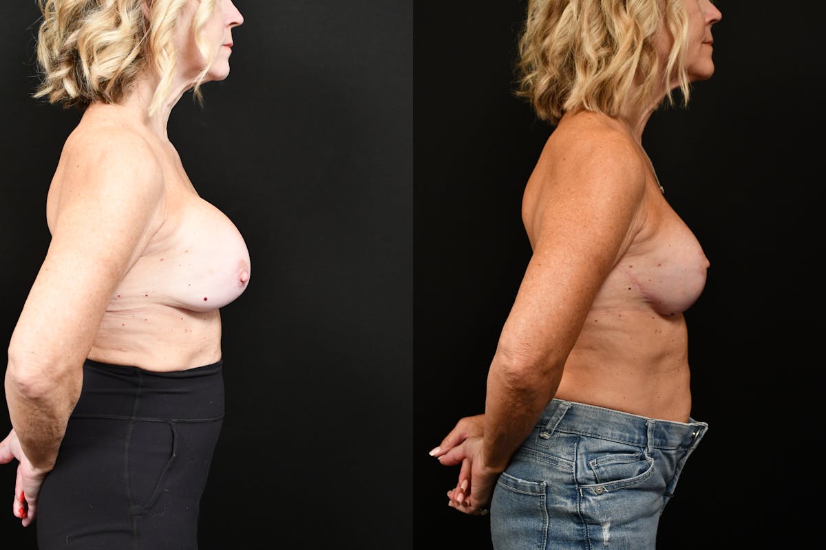Reductive Augmentation Before & After Gallery - Patient 349280 - Image 3