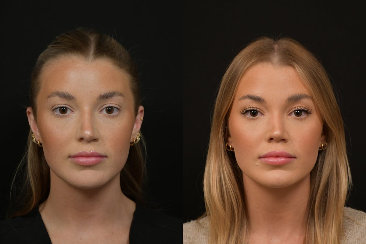 Rhinoplasty Before & After Gallery - Patient 248359 - Image 1