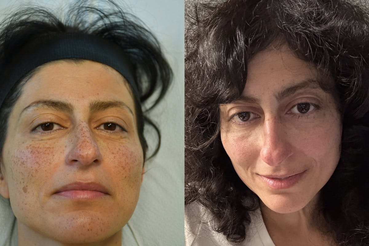 Lasers Before & After Gallery - Patient 245932 - Image 2