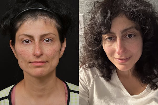 Lasers Before & After Gallery - Patient 245932 - Image 1