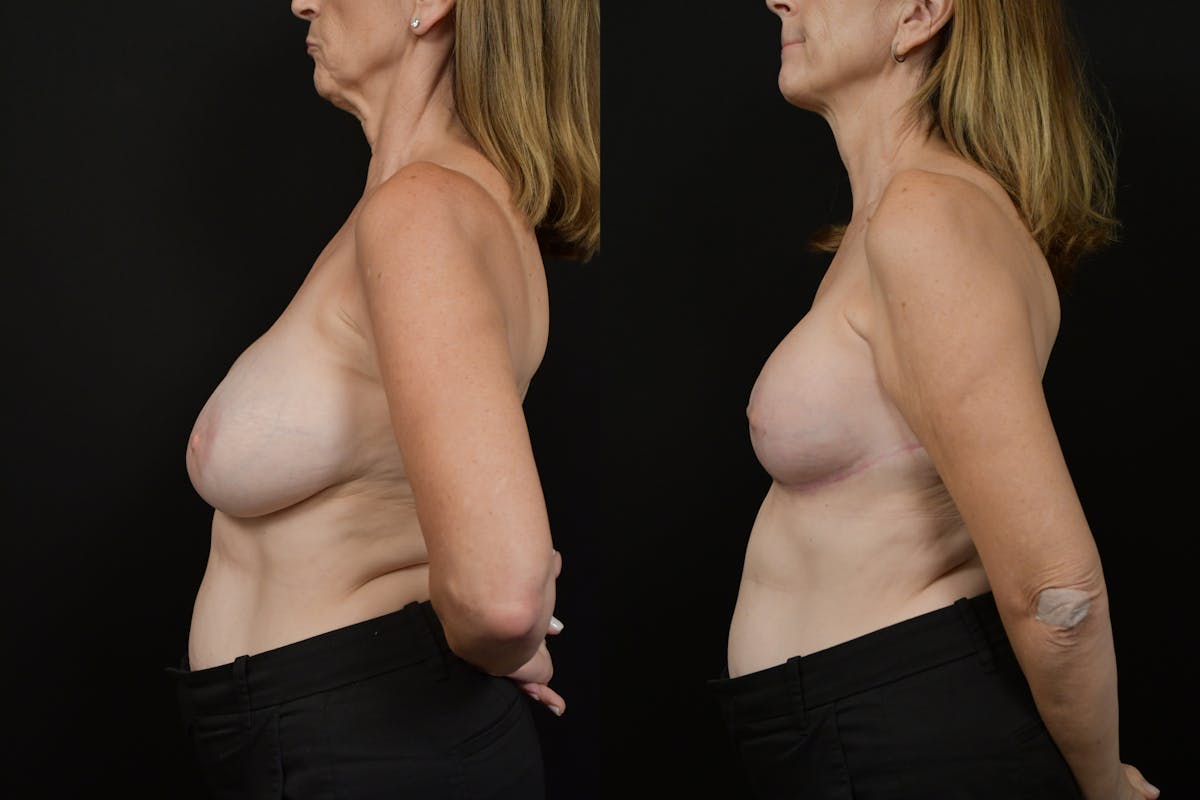 Reductive Augmentation Before & After Gallery - Patient 259359 - Image 5