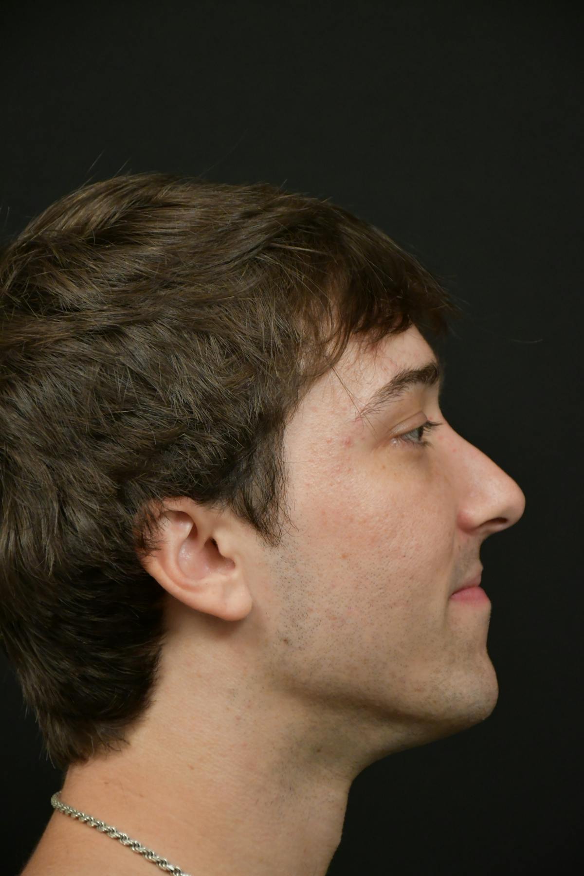 Skin Rejuvenation Before & After Gallery - Patient 314208 - Image 5