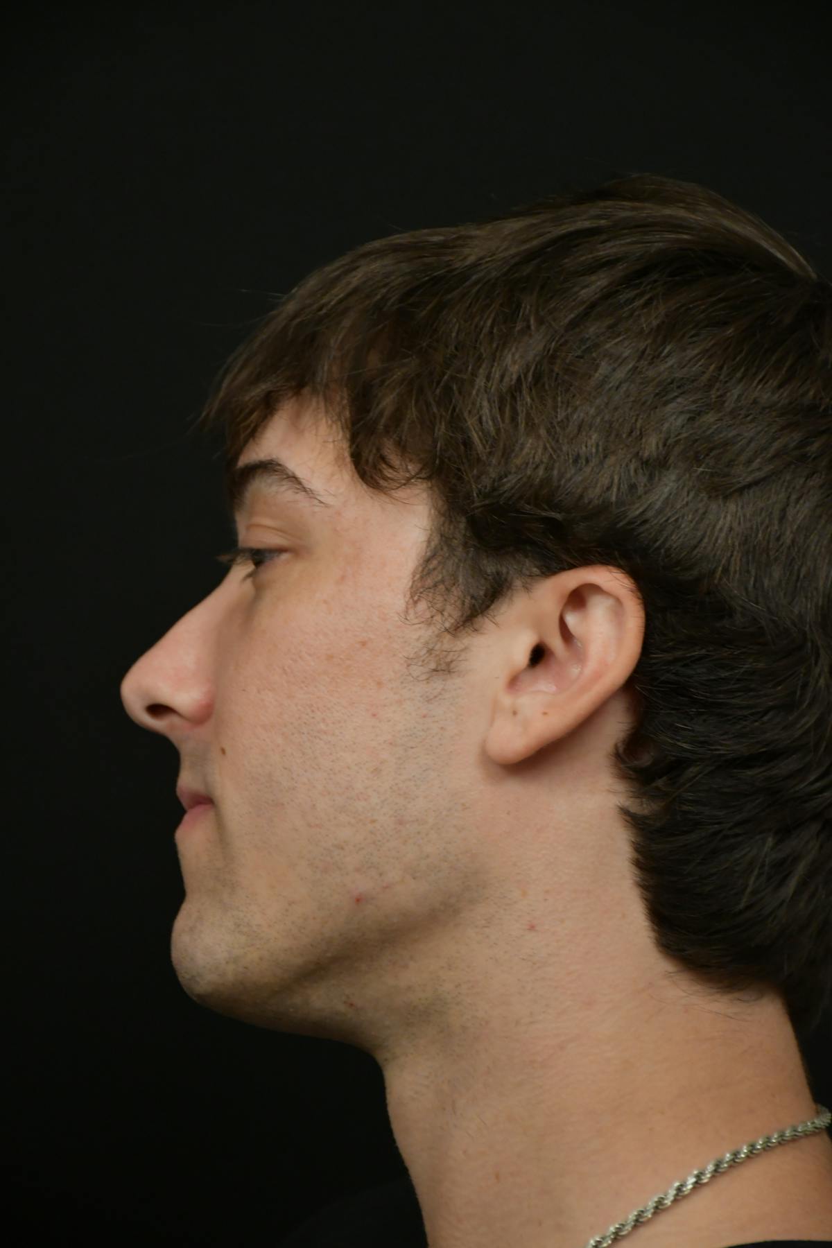 Skin Rejuvenation Before & After Gallery - Patient 314208 - Image 3