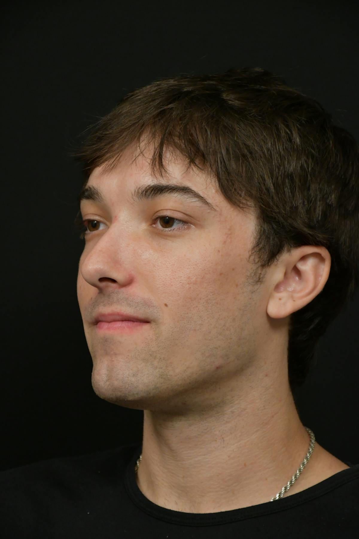 Skin Rejuvenation Before & After Gallery - Patient 314208 - Image 2