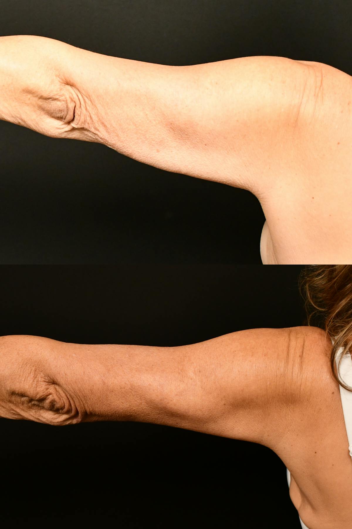 Arm Lift Before & After Gallery - Patient 334386 - Image 3