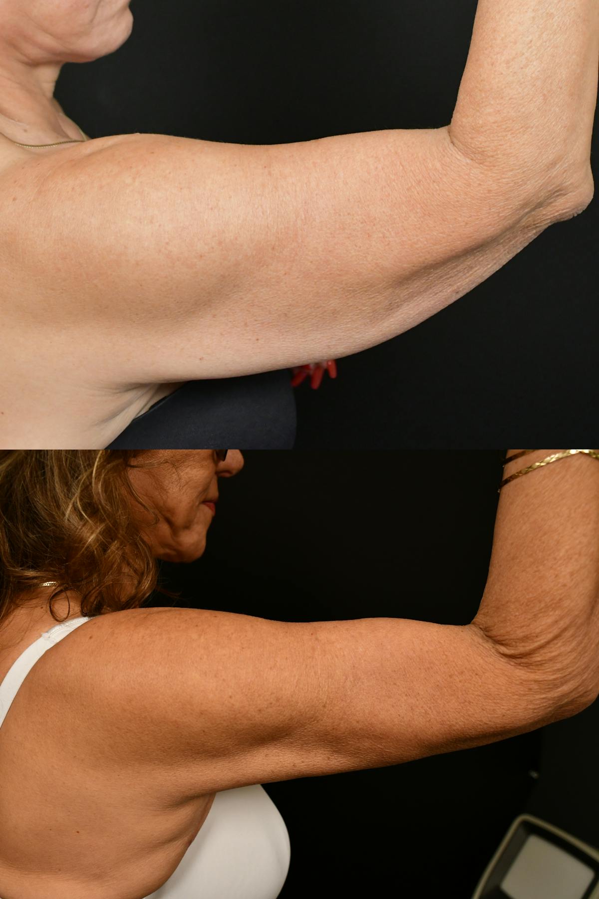 Arm Lift Before & After Gallery - Patient 334386 - Image 5