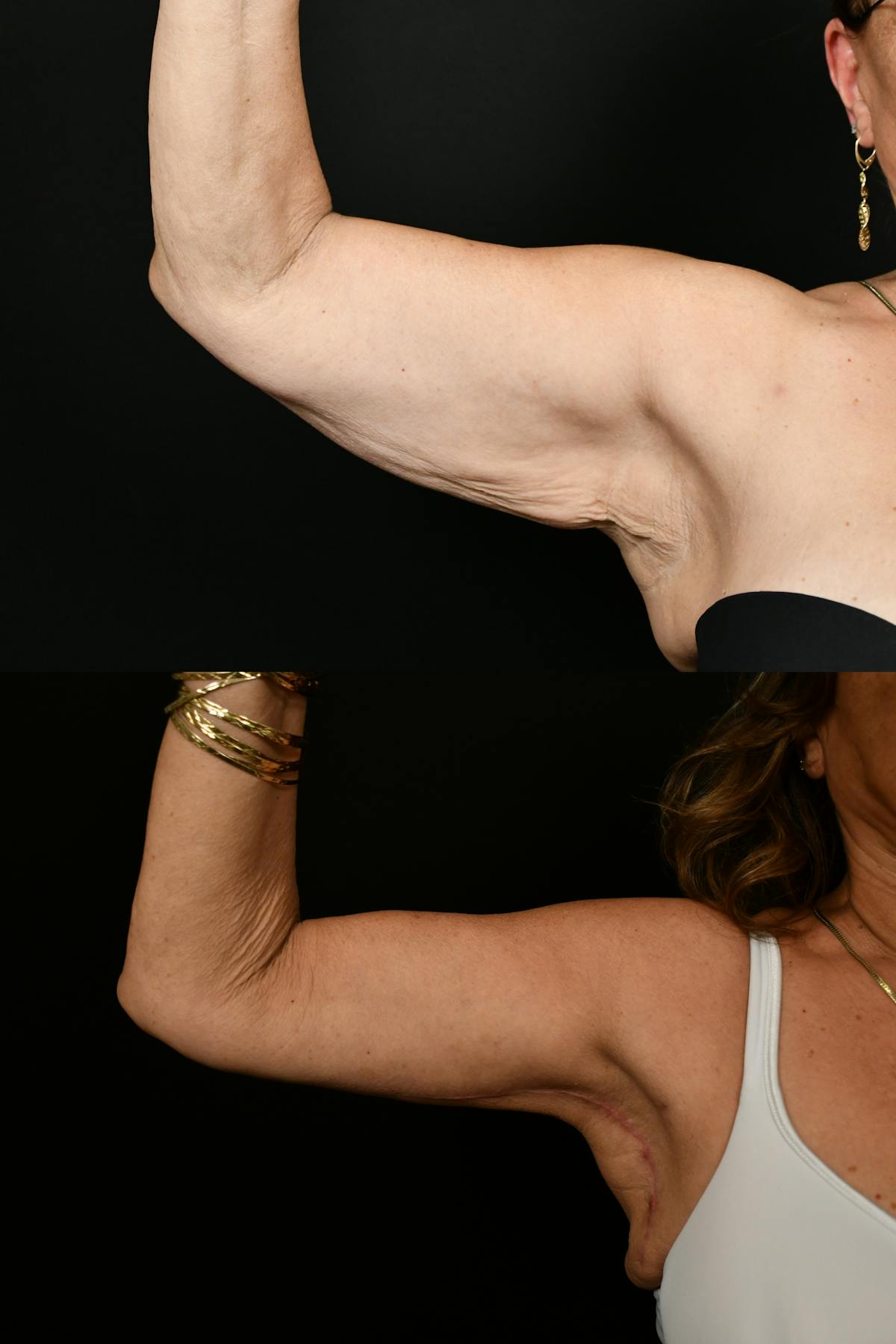 Arm Lift Before & After Gallery - Patient 334386 - Image 8