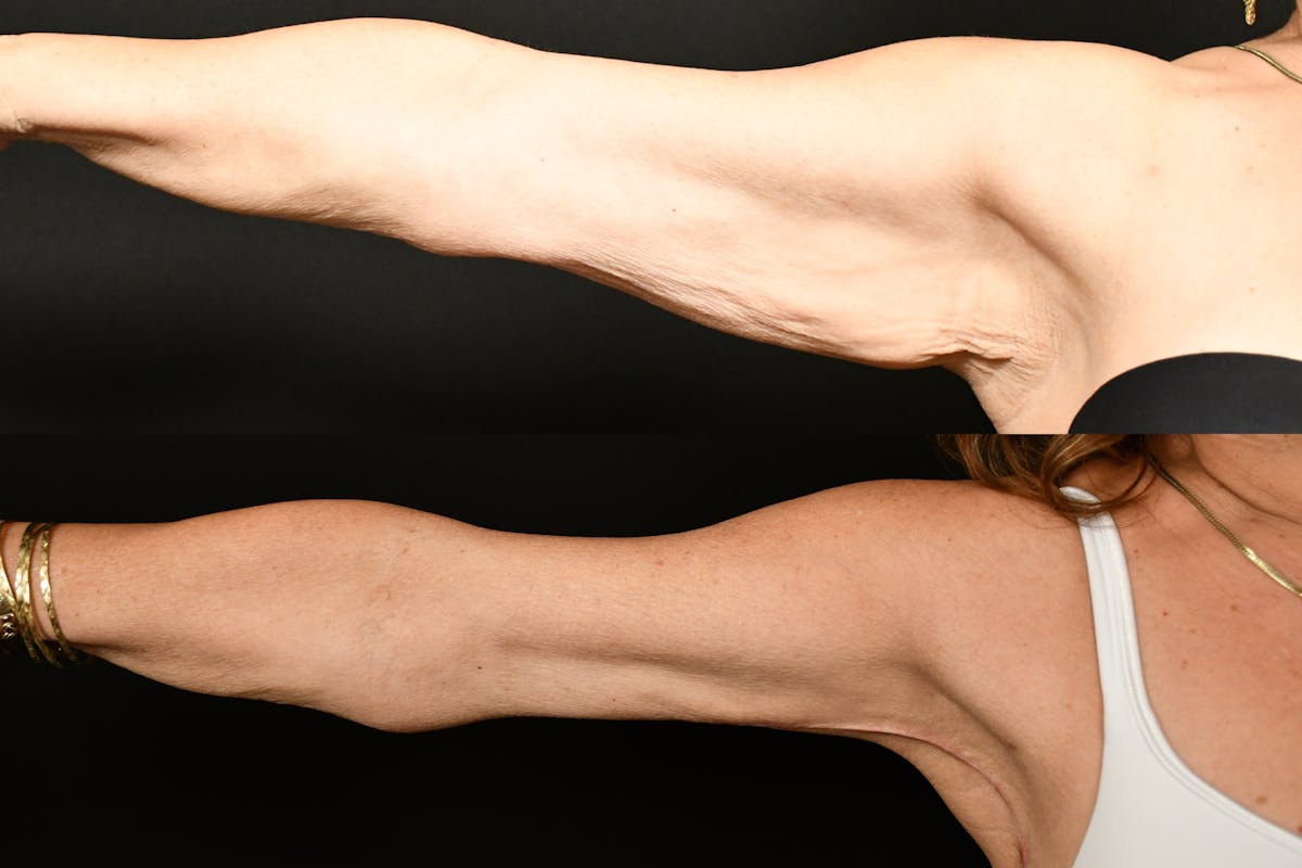 Arm Lift Before & After Gallery - Patient 334386 - Image 1