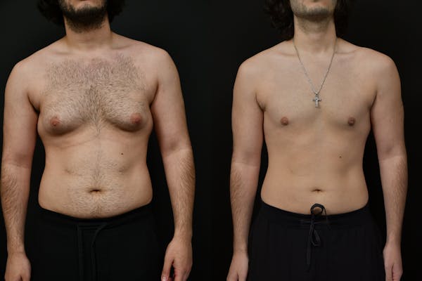 Gynecomastia Before & After Gallery - Patient 391542 - Image 1