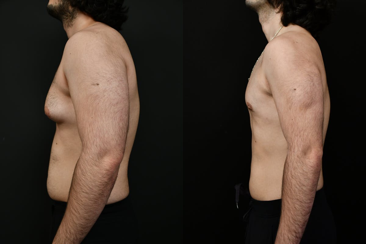 Gynecomastia Before & After Gallery - Patient 391542 - Image 5