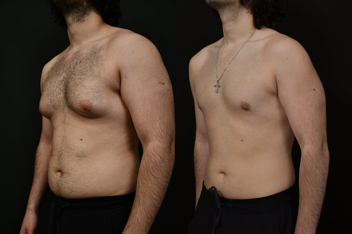 Gynecomastia Before & After Gallery - Patient 391542 - Image 4