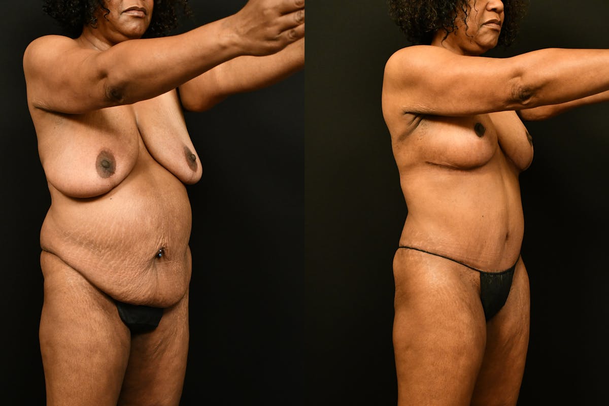 Mommy Makeover Before & After Gallery - Patient 988351 - Image 8