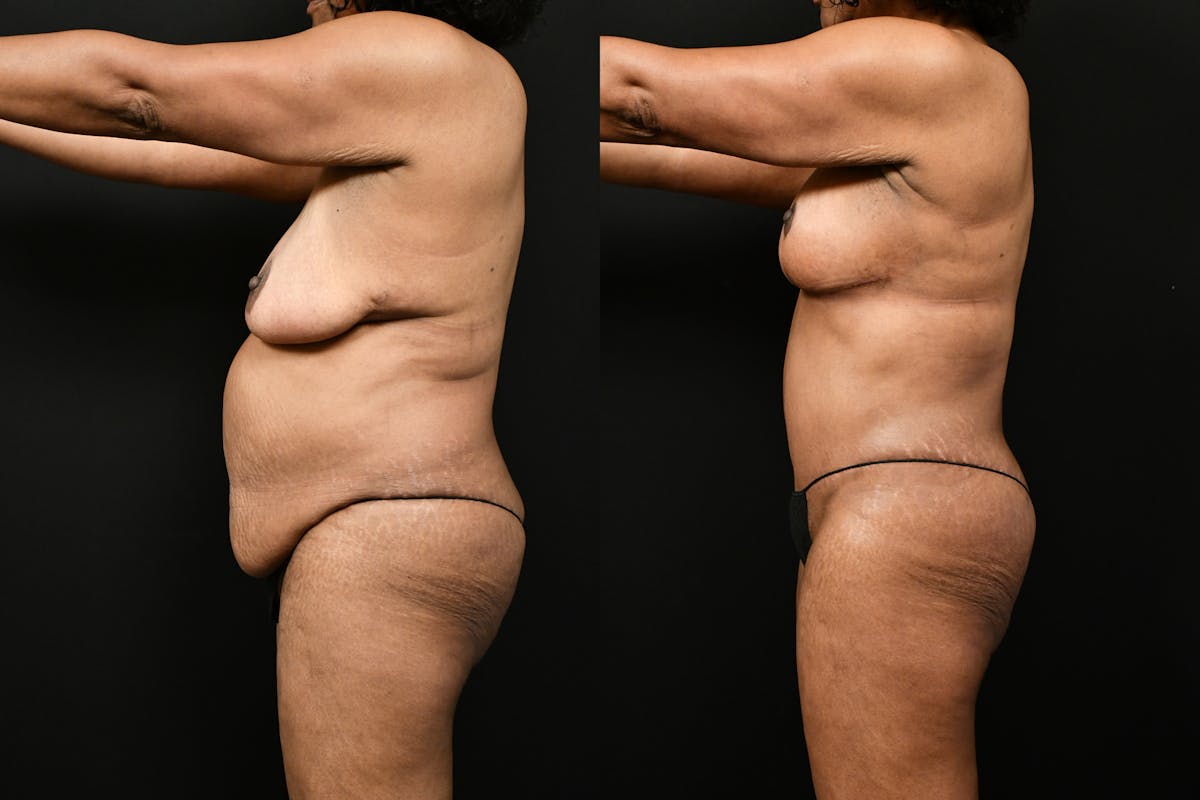 Mommy Makeover Before & After Gallery - Patient 988351 - Image 3