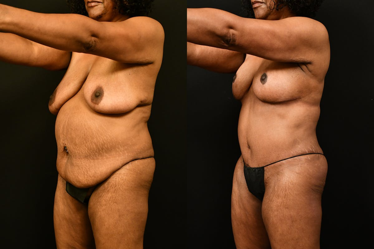 Mommy Makeover Before & After Gallery - Patient 988351 - Image 2