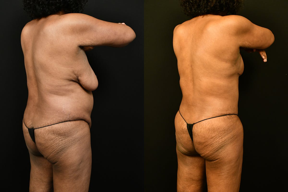 Mommy Makeover Before & After Gallery - Patient 988351 - Image 6