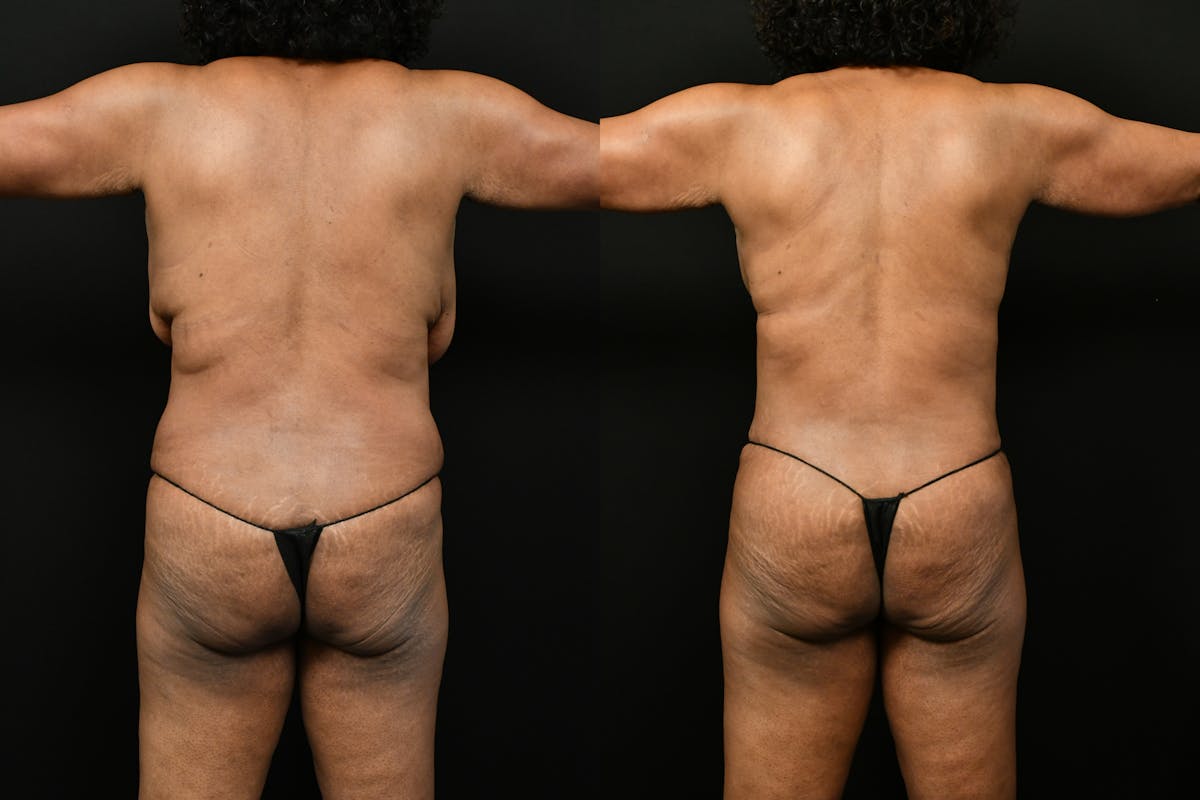 Mommy Makeover Before & After Gallery - Patient 988351 - Image 5