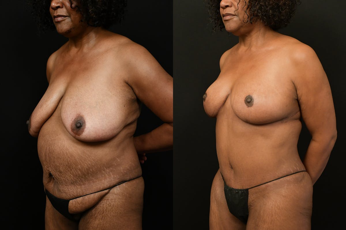 Breast Reduction Before & After Gallery - Patient 321080 - Image 4