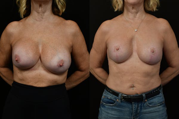 Reductive Augmentation Before & After Gallery - Patient 349280 - Image 1