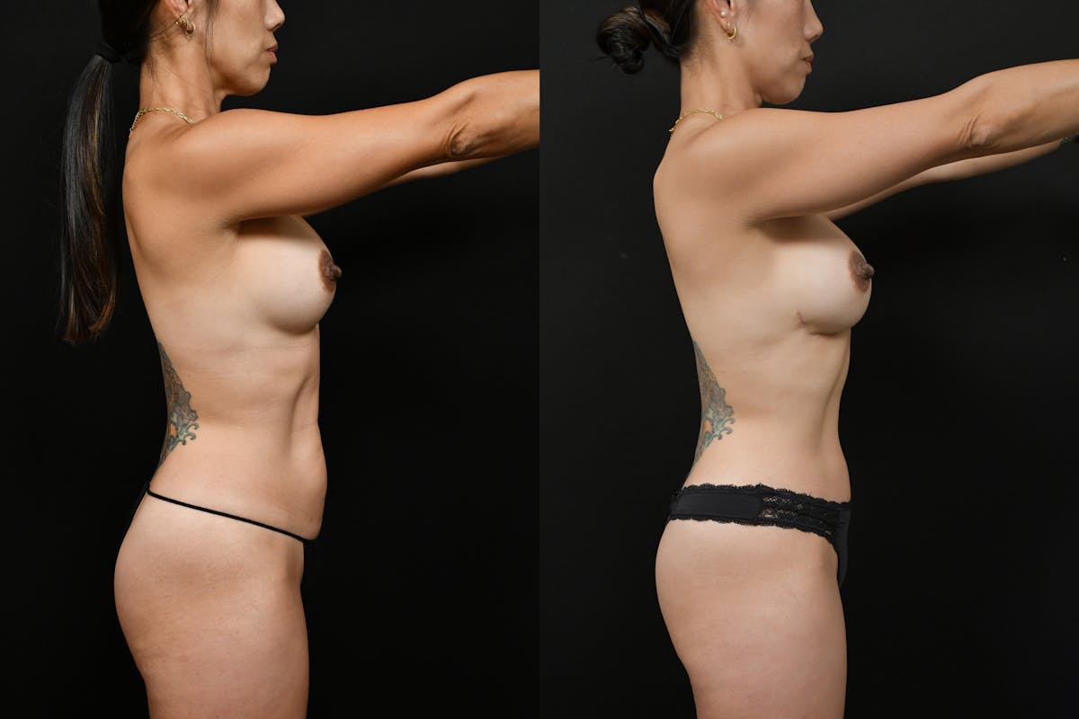 Reverse Tummy Tuck Before & After Gallery - Patient 486800 - Image 3