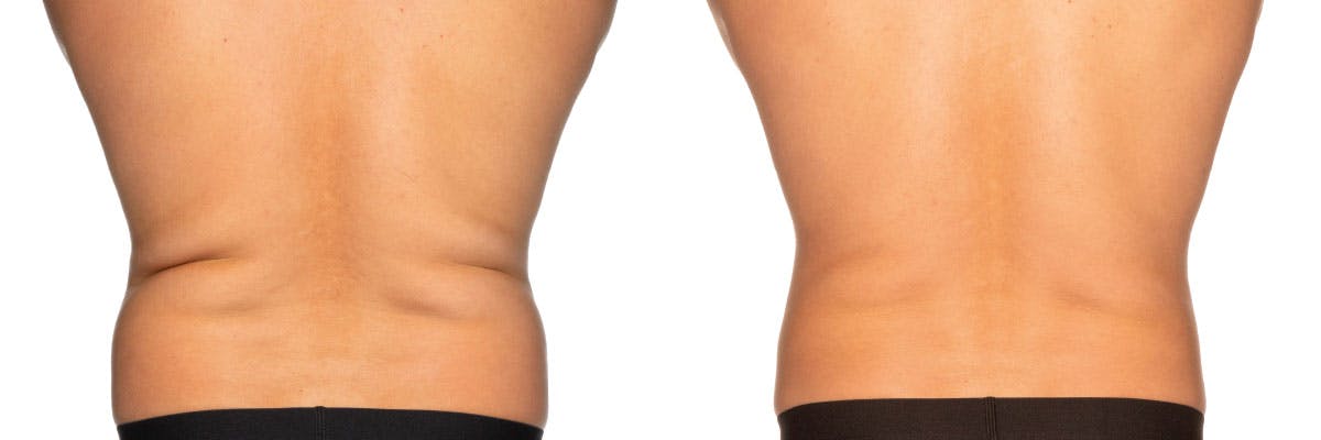 Before and after photos of coolsculpting elite patient