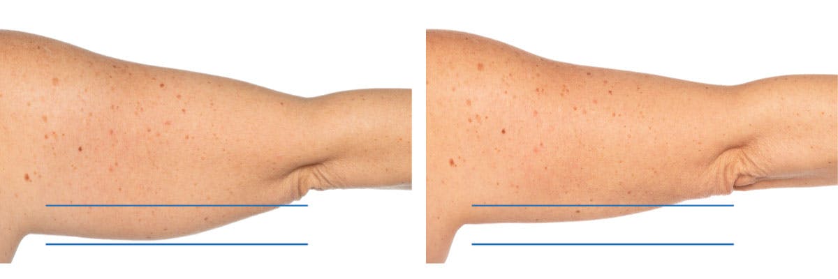 Before and after photos of coolsculpting elite patient