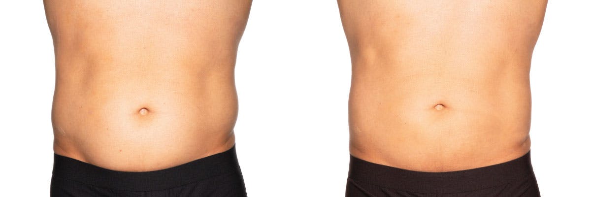Before and after photos of coolsculpting elite patient