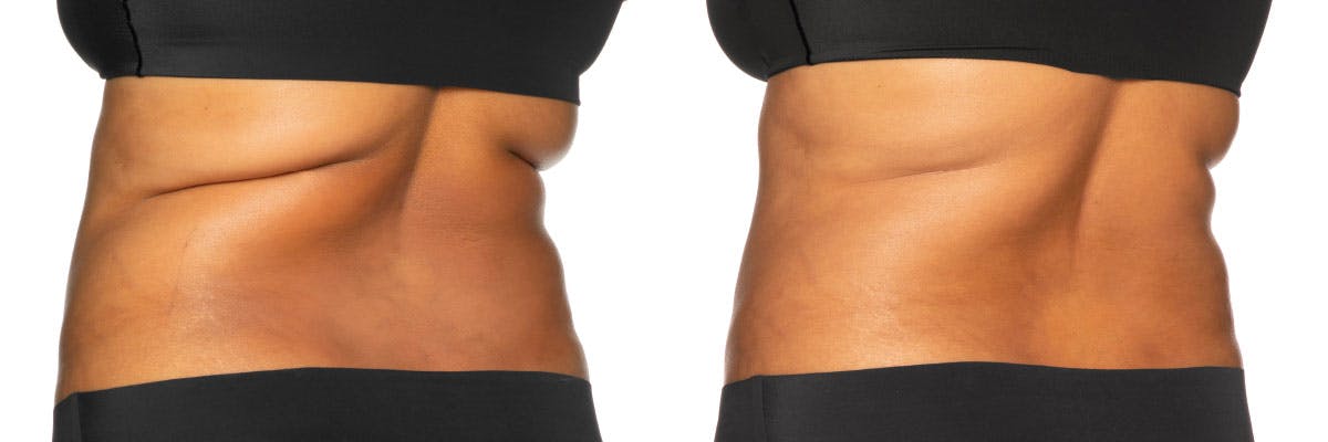 Before and after photos of coolsculpting elite patient