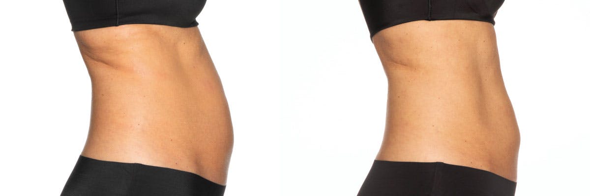 Before and after photos of coolsculpting elite patient